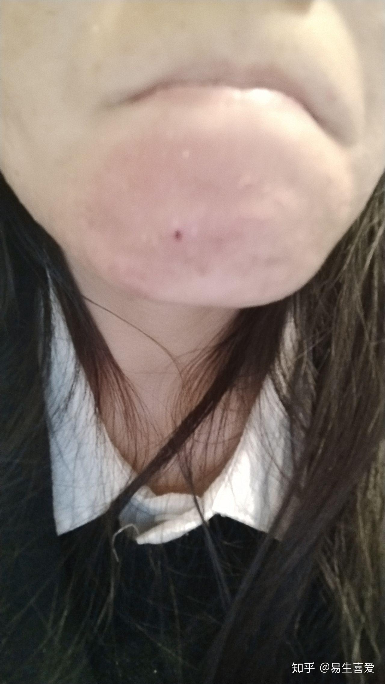 疖肿治疗亲身得过