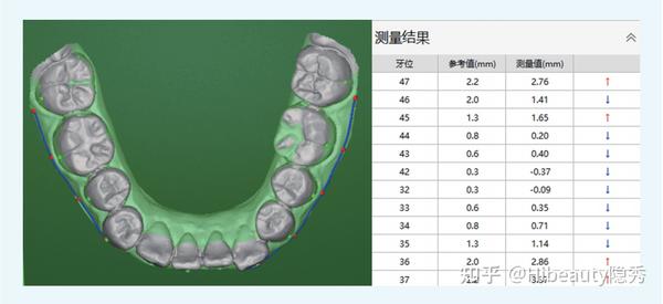 Hibeauty隐秀「牙列拥挤/隐形矫治器拔牙矫治」案例分享 - 知乎