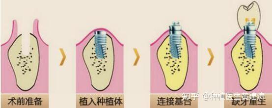 精神障礙,嚴重骨質疏鬆,傳染性及骨代謝疾病的人是不適合做種植牙手術