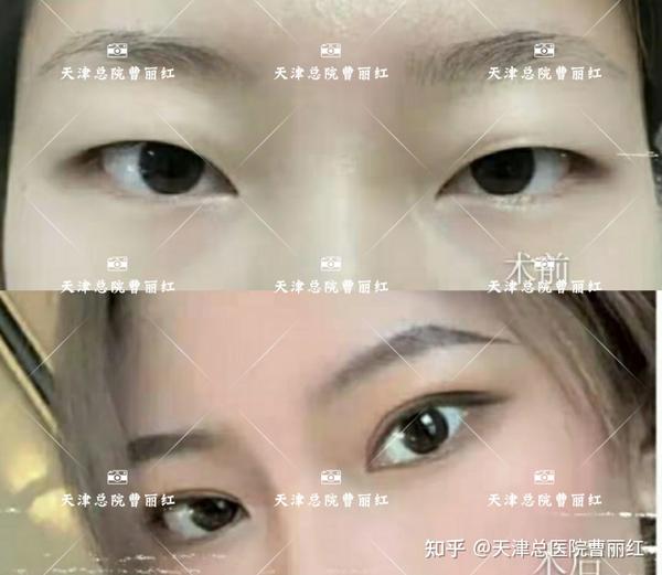 天津总院曹丽红:成功的双眼皮 - 知乎