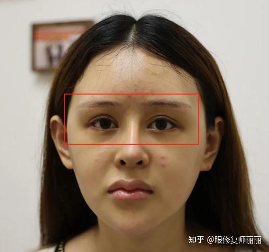 师丽丽眼修复丨做完双眼皮后眉眼间距变窄了,可以修复调整吗?