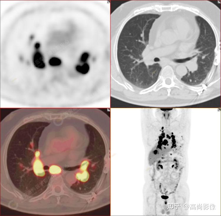 西安高尚petctmr診斷結節病雙肺及全身多發淋巴結廣泛累及1例