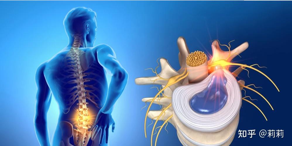 腰椎间盘这个部位每天都需要承受较大的压力,需支撑腰椎,还要起到缓冲