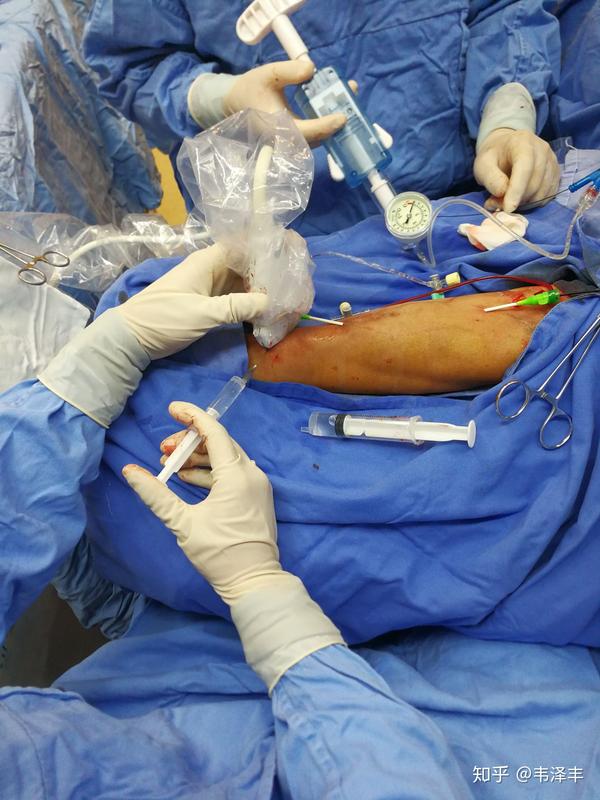 b超引导下内瘘溶栓 球囊扩张术 - 知乎