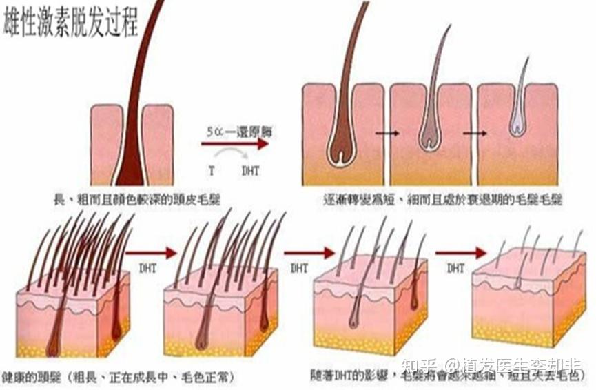 巴西植发多久能做(巴西植发多久能做头发拉直)