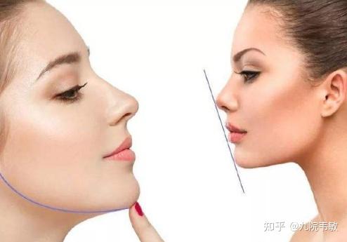 九院韦敏说,各种类型的隆颏方式应该如何选择