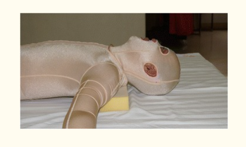 烧伤穿弹力衣要多长时间烧伤弹力衣什么时候穿烧伤疤痕充血穿弹力衣