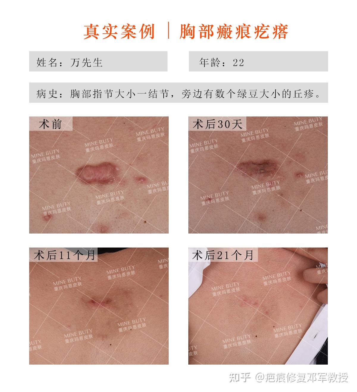 疤痕疙瘩好转的迹象是什么? - 知乎