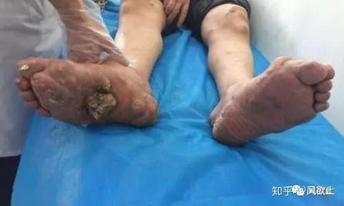 或) 尿酸排泄减少所引起的一种晶体性关节炎,临床表现为高尿酸血症和