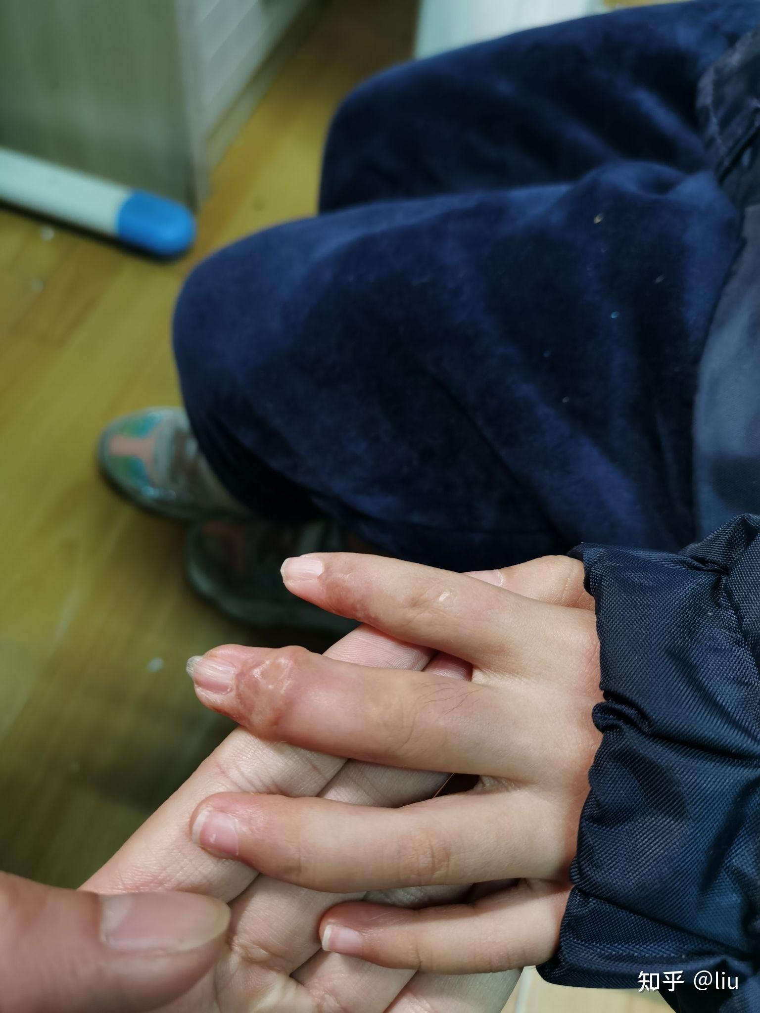 这包涵体纤维瘤 好发于手指跟脚指小朋友手指中指 食指包涵体纤维瘤