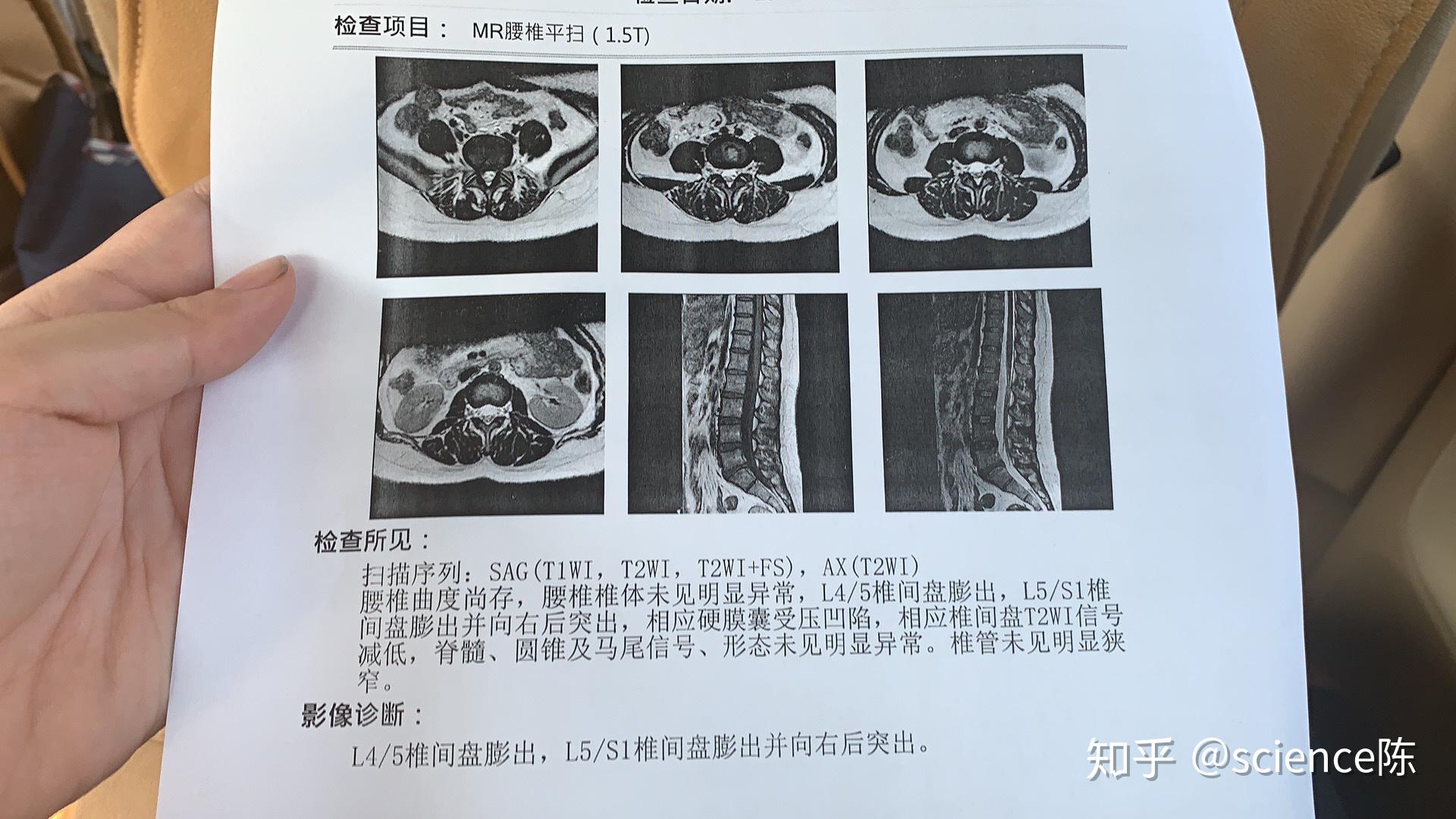 市中心醫院專家看到磁共振片子後,確診椎間盤突出,l4-5膨出,l5-s1膨出