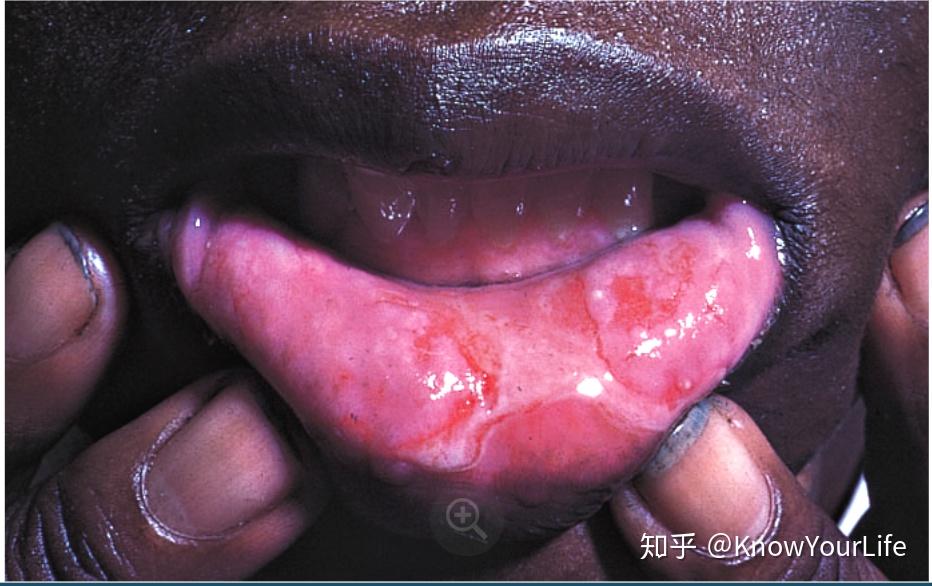 【史上最全医学科普10】贝赫切特病(白塞病)
