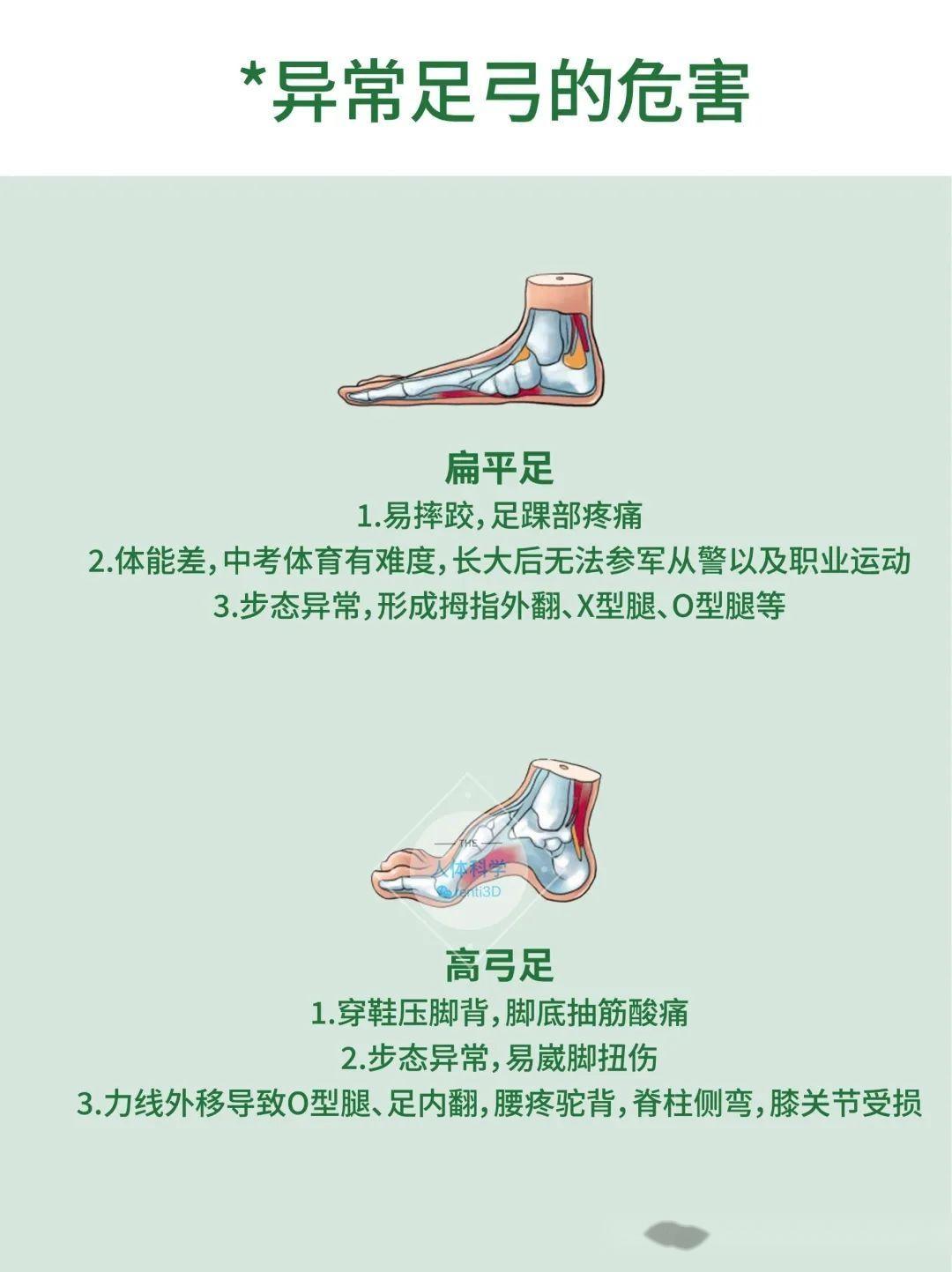 【体态评估】足弓对腿型和身体力线的影响 - 知乎