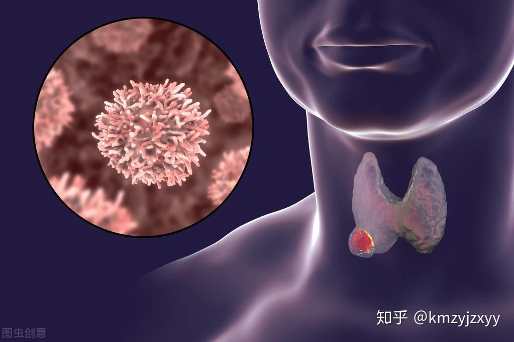 甲狀腺癌發生淋巴結轉移?不要灰心,還是有辦法治癒的!