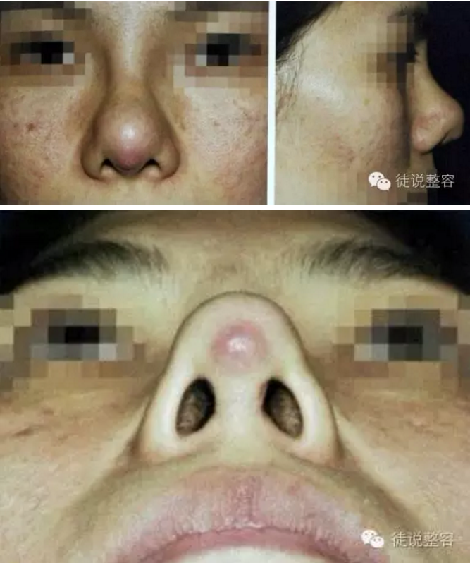 原创科普硅胶和膨体隆鼻假体材料的特性优缺点并发症讲解