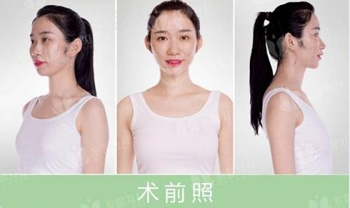 鼻子很塌怎麼辦廣州紫馨真人案例