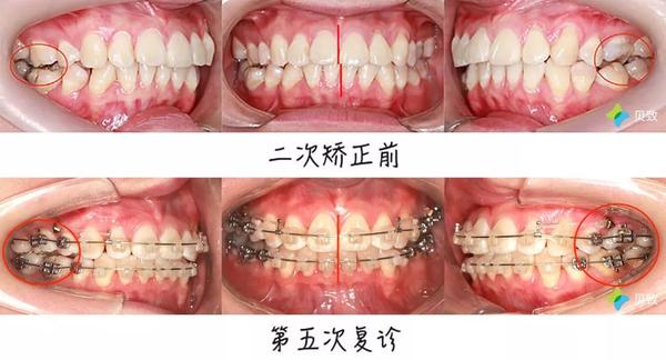 矫正故事丨 我第一次矫正完的样子 可真吓人 知乎