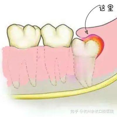 智齿发炎可以直接拔掉吗 知乎