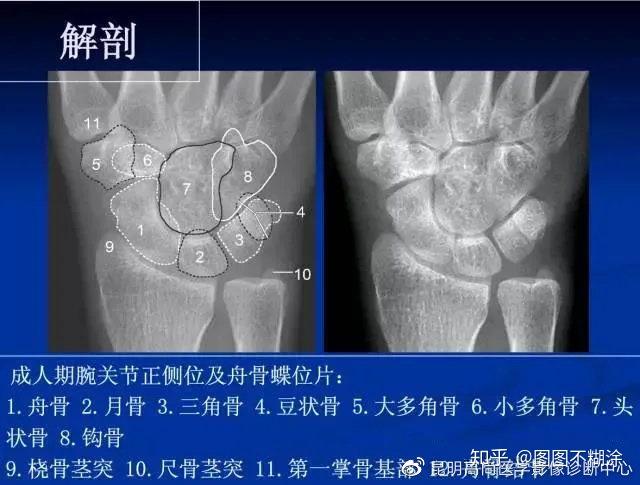 手掌x光片图及讲解图片