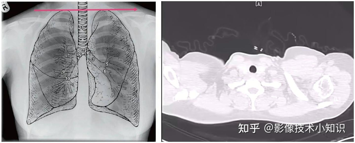 怎么在ct上识别肺的分段和支气管 知乎 