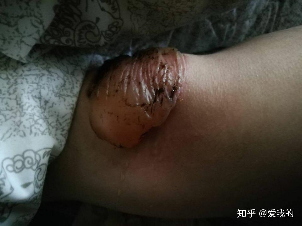 贴完膏药后起得水泡