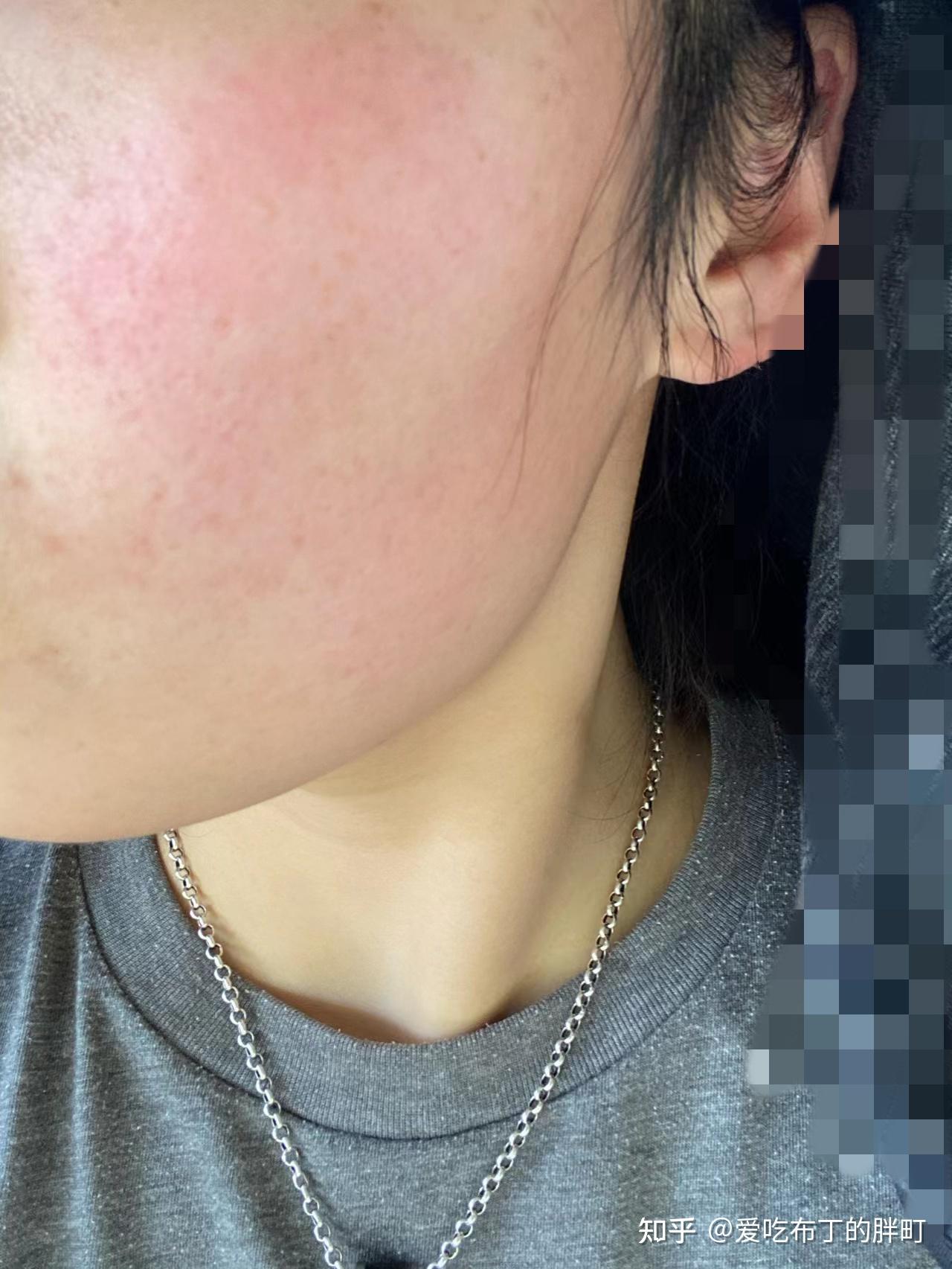 脸上皮肤特别薄,很容易变红,该如何改善啊? - 知乎