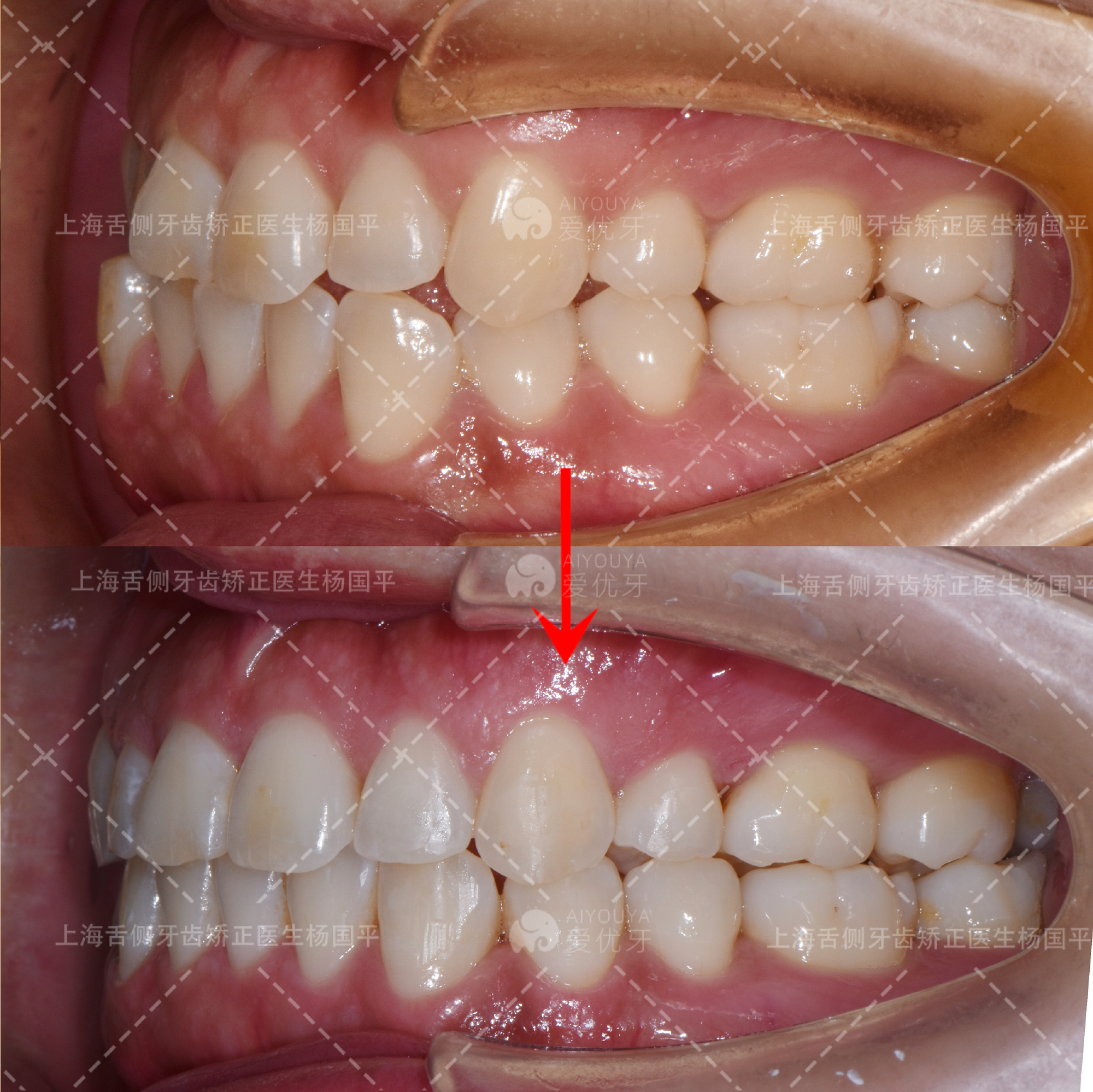 上海牙齿矫正:两次外院矫正反弹,正畸三次矫正优化微笑线 - 知乎