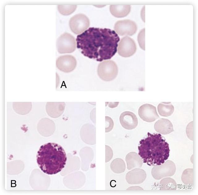 上圖:慢性髓系白血病患者外周血的嗜鹼性粒細胞(可見3個)05