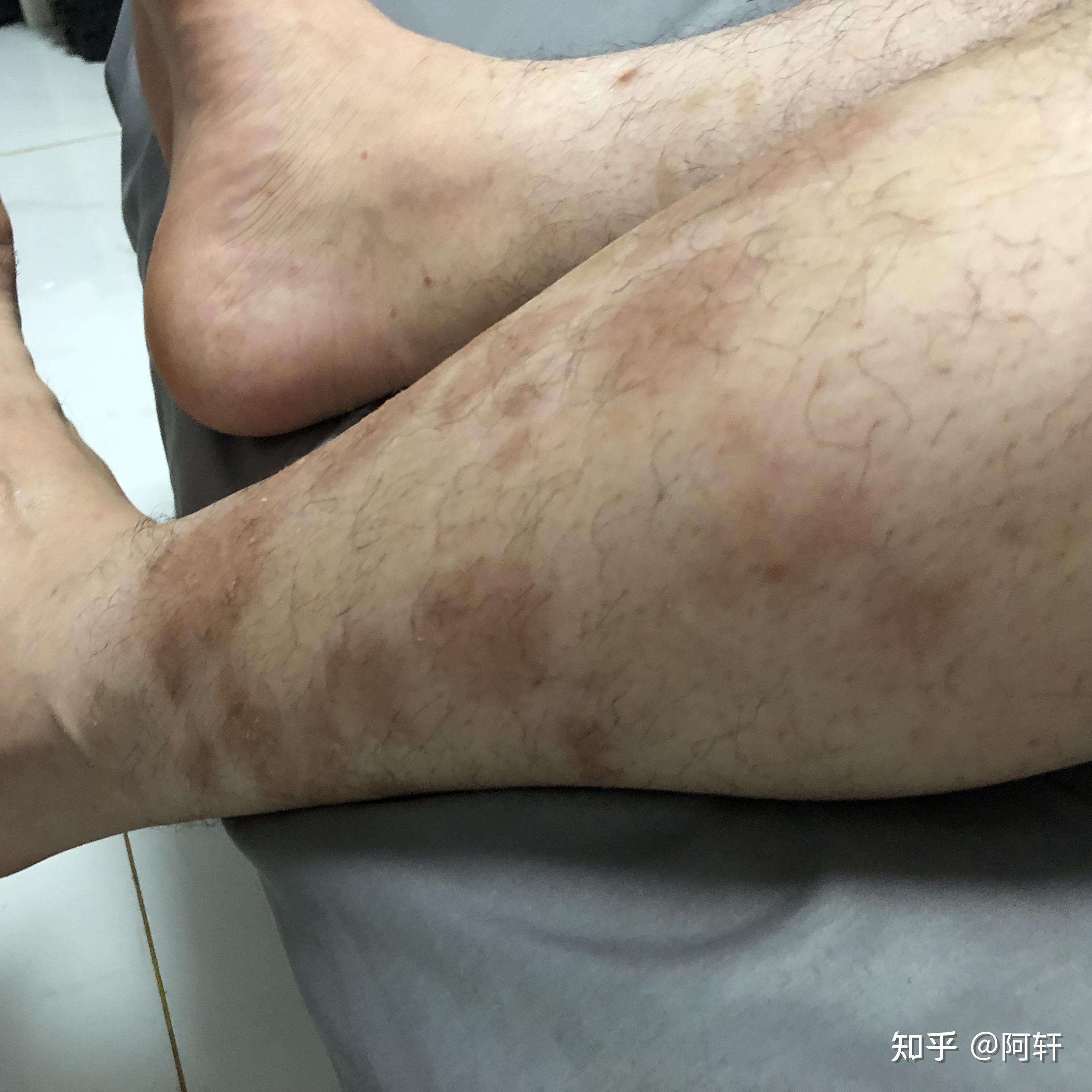 9年牛皮癣心得!