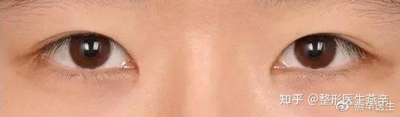 女子割双眼皮割成三眼皮 割完双眼皮后变三眼皮 割双眼皮成三眼皮