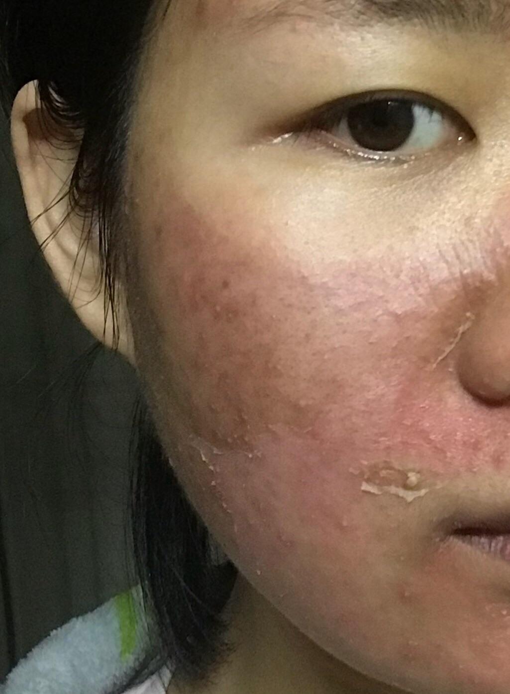 光动力治疗痤疮的效果好吗?