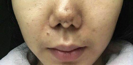 膨体隆鼻感染了有多严重