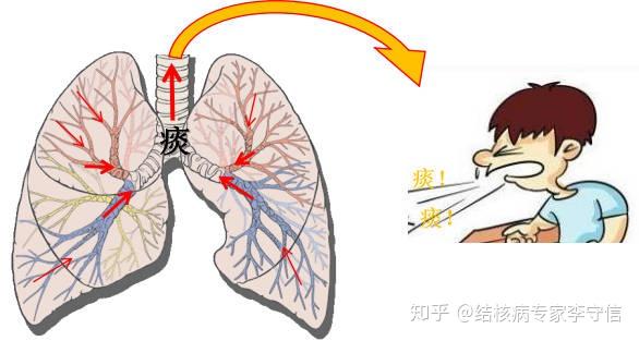 ④支氣管或縱隔,肺門淋巴結結核,因腫大的淋巴結壓