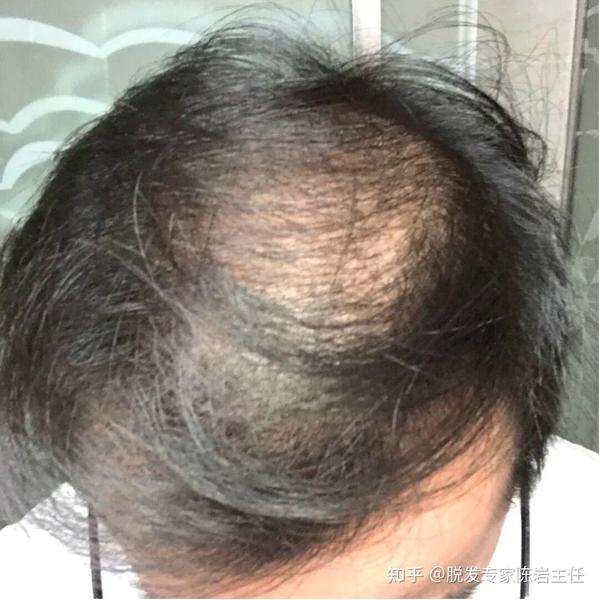 发缝宽出油多,头发稀疏 细软,三步解决! - 知乎