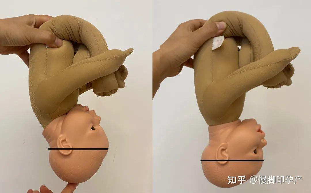 个俯屈的动作(让下巴贴在胸口),让枕骨到额头的直径(枕额径)变小一些