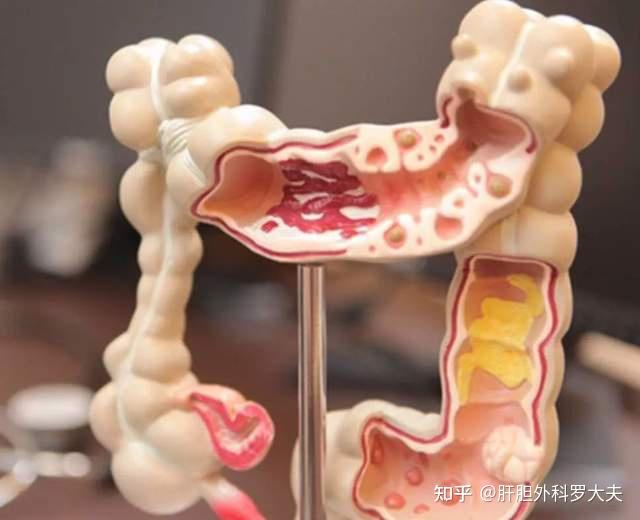 大便出血是痔疮?女患者到医院见是男医生临阵脱逃,半年后背粪袋