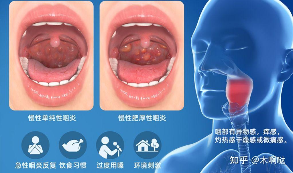 慢性咽炎挂什么科?耳鼻喉?内科? - 知乎