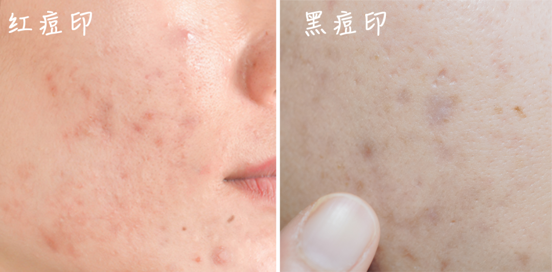 痘印一般多久会消失?有解决办法! - 知乎
