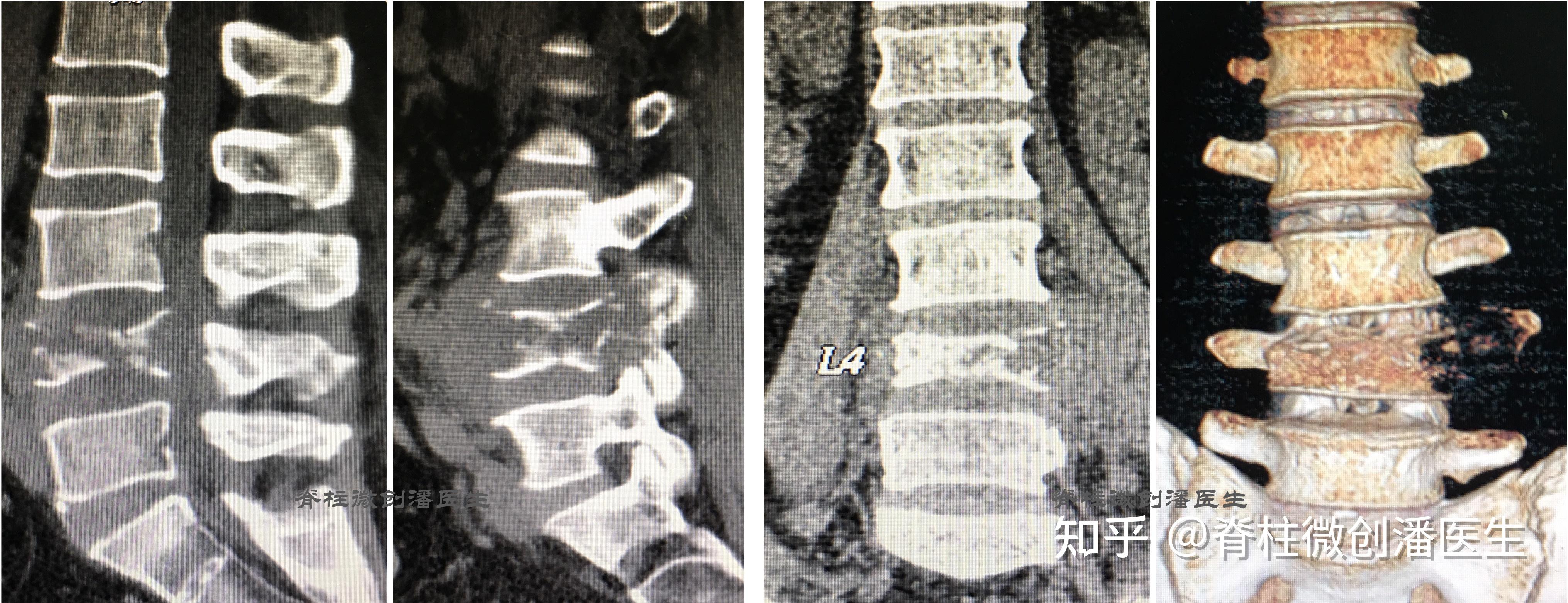 最常见的脊柱肿瘤脊柱转移瘤