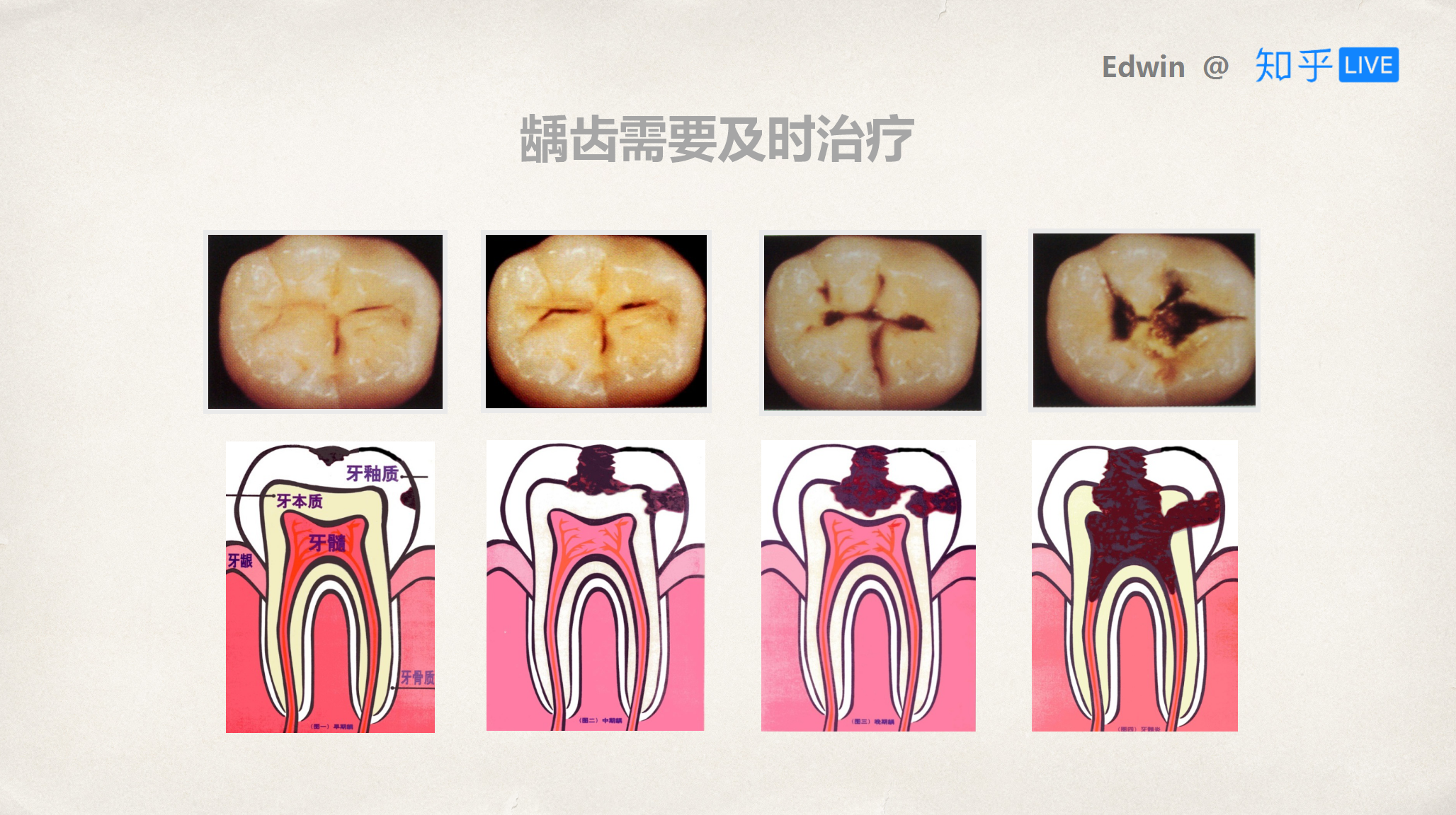 广州种牙过程记录 - 知乎