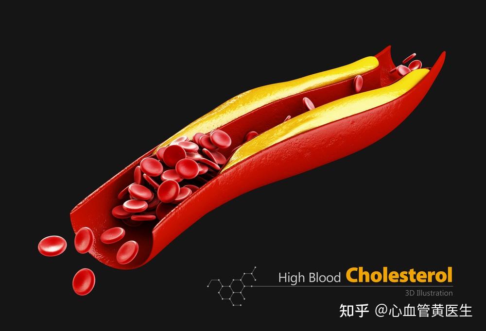 血管堵了是因为血管内有毒素血管需要定期排毒医生告诉你真相