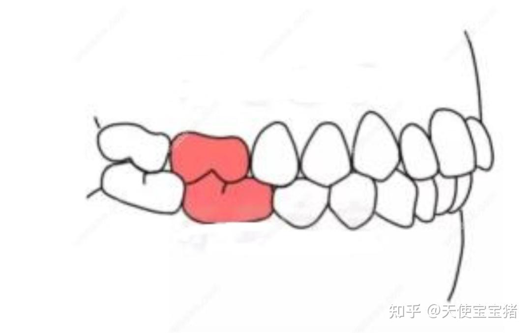 咱們健康的牙頜是這樣的(沒有錯位哈,上下頜第一恆磨牙,牙尖對牙溝才