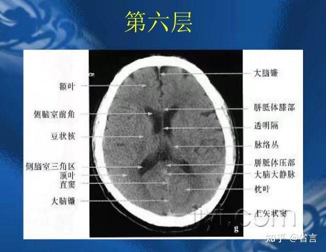 颅脑ct八个层面清晰图图片