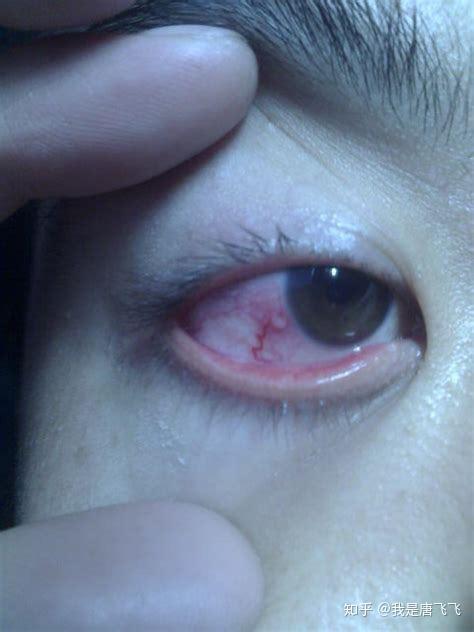 史上最强的隐形美瞳避坑教程从此无良商家绕路走