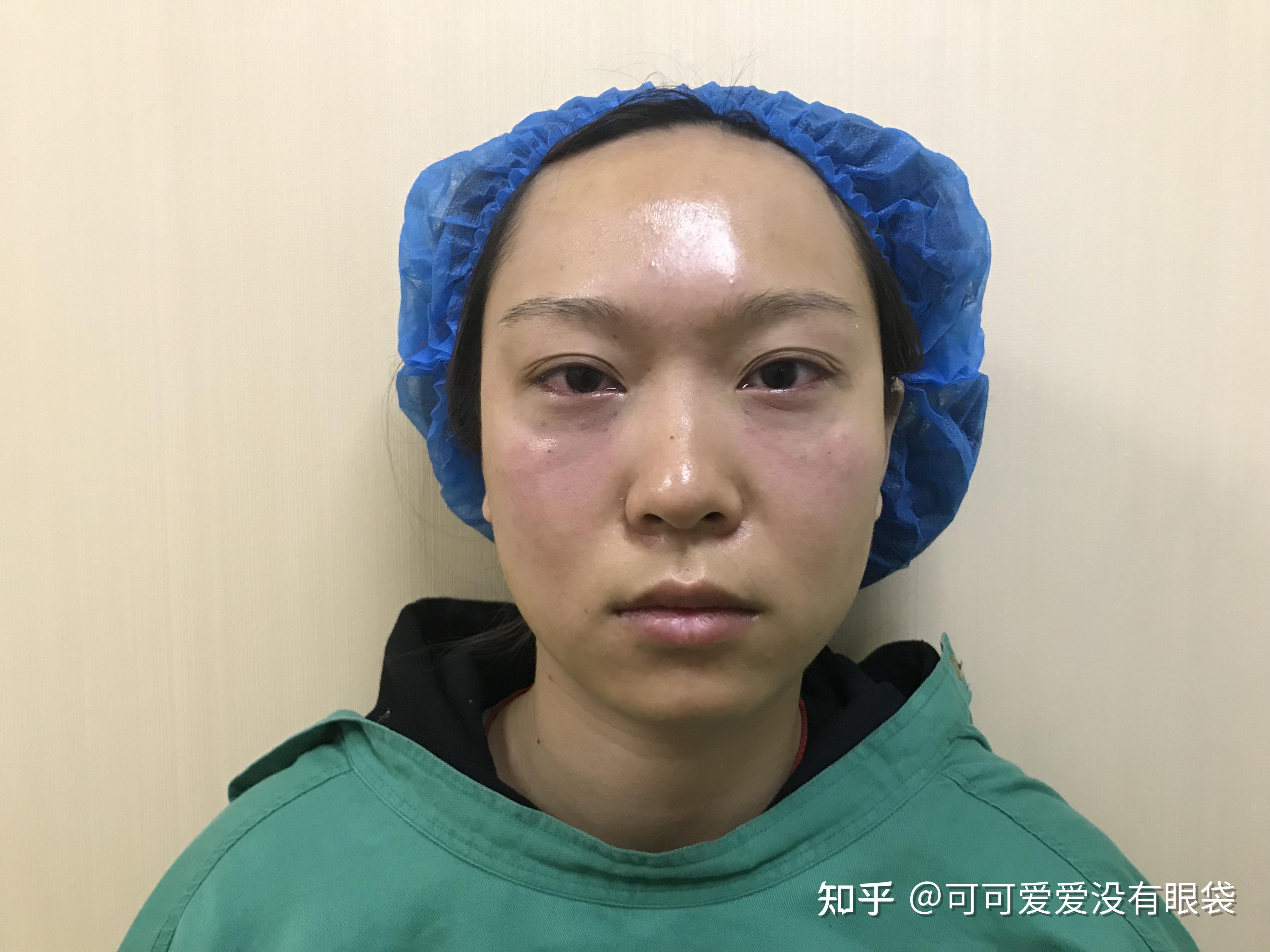 亲身体验分享做完去眼袋手术的心路历程