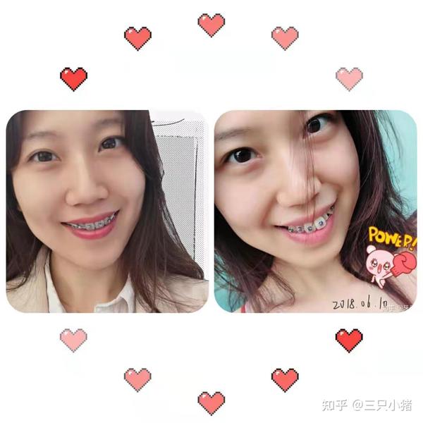 完结啦~~28岁拔牙打骨钉正畸,舌侧丝保持器记录贴,详尽的整牙手册 - 知乎
