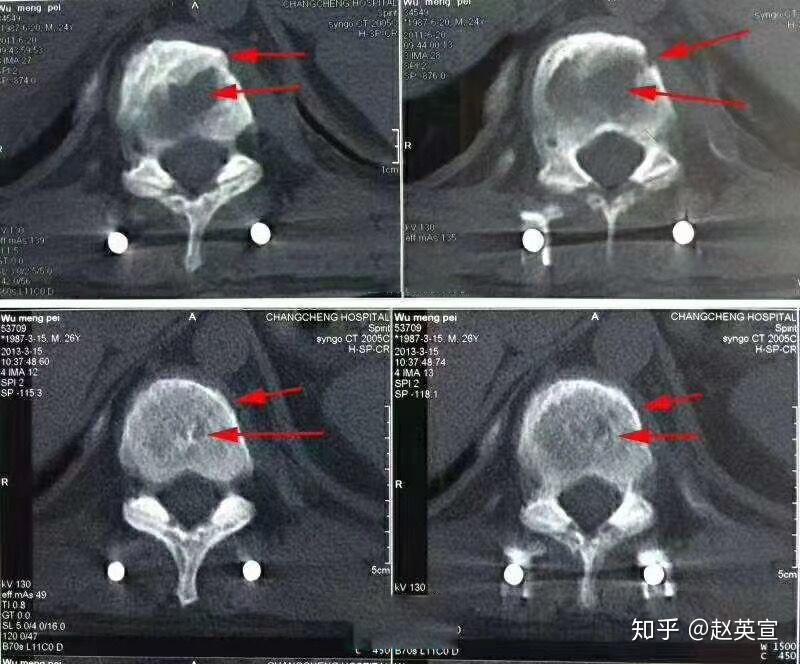 骨结核ct影像表现图片