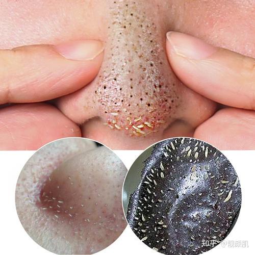 我该拿这个巨大的黑头怎么办? - 知乎