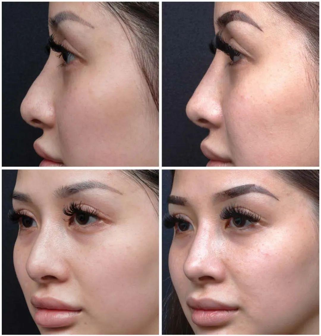 1毫升高强度,高弹性的透明质酸,鼻小柱0.2毫升,鼻背0.