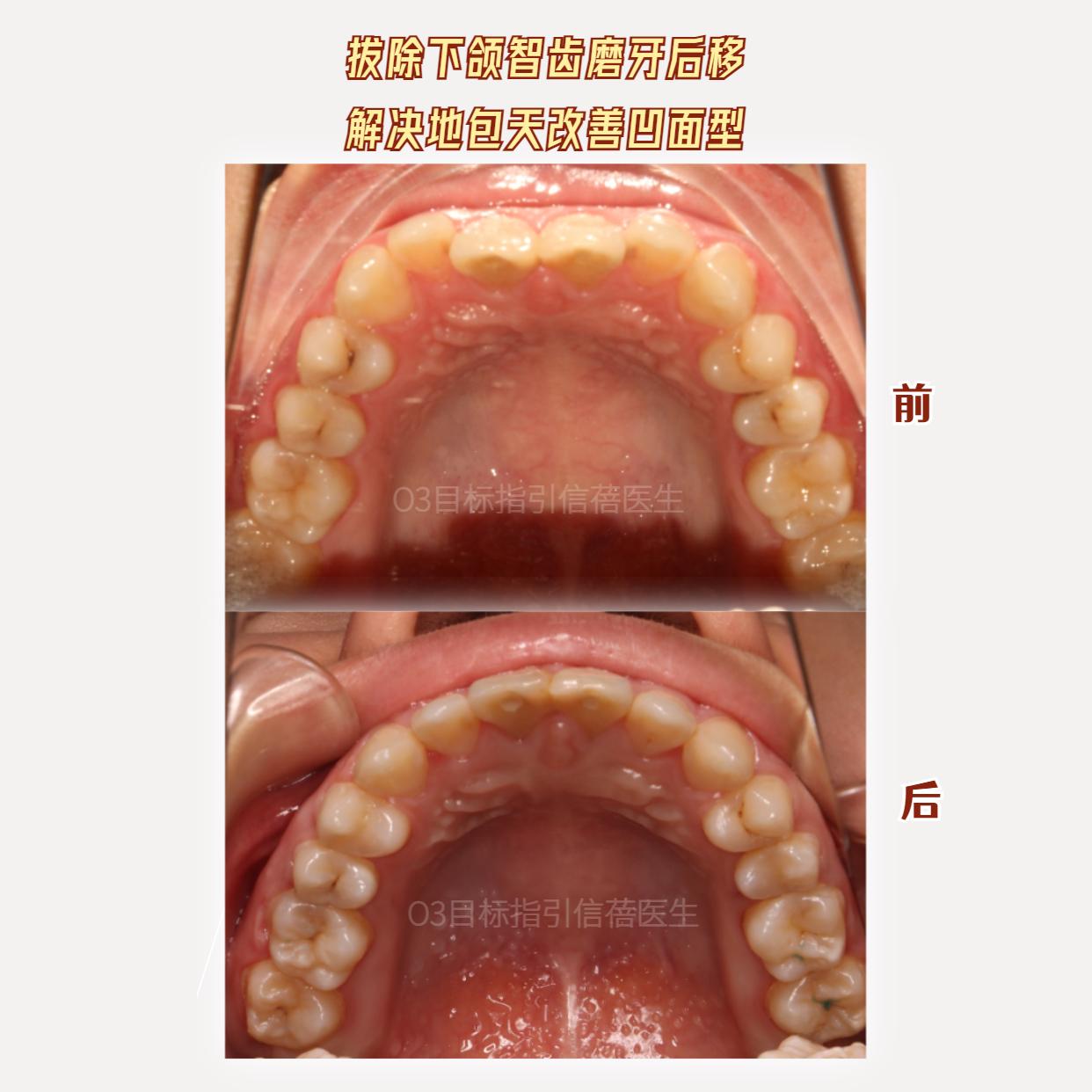 深圳牙齒拔除下頜智齒後移磨牙解決地包天改善凸面型